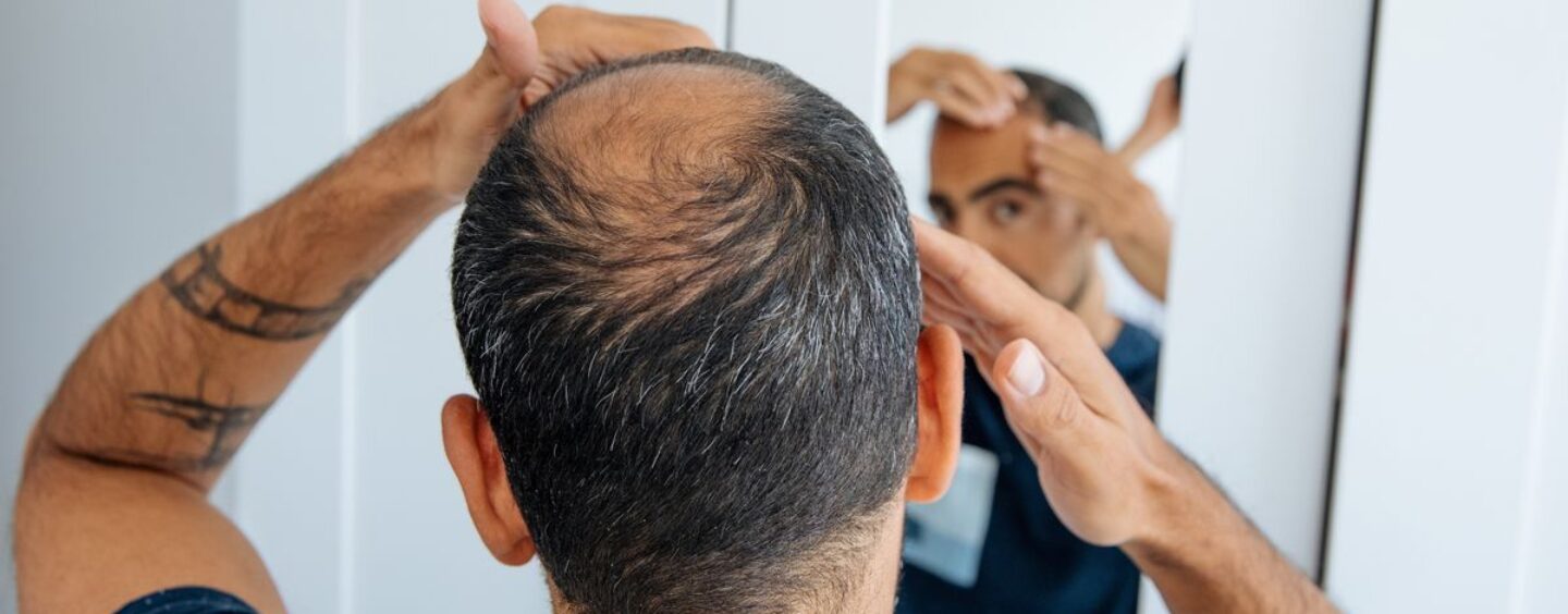 Les experts médicaux expliquent les greffes de cheveux et pourquoi les gens trans font la queue pour les obtenir