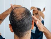 Les experts médicaux expliquent les greffes de cheveux et pourquoi les gens trans font la queue pour les obtenir