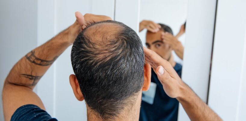 Les experts médicaux expliquent les greffes de cheveux et pourquoi les gens trans font la queue pour les obtenir
